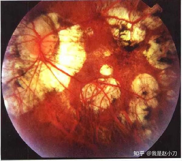 1.避免高度近视眼底并发症：高度近视中老年后会频繁遭受眼病困扰2.增加近