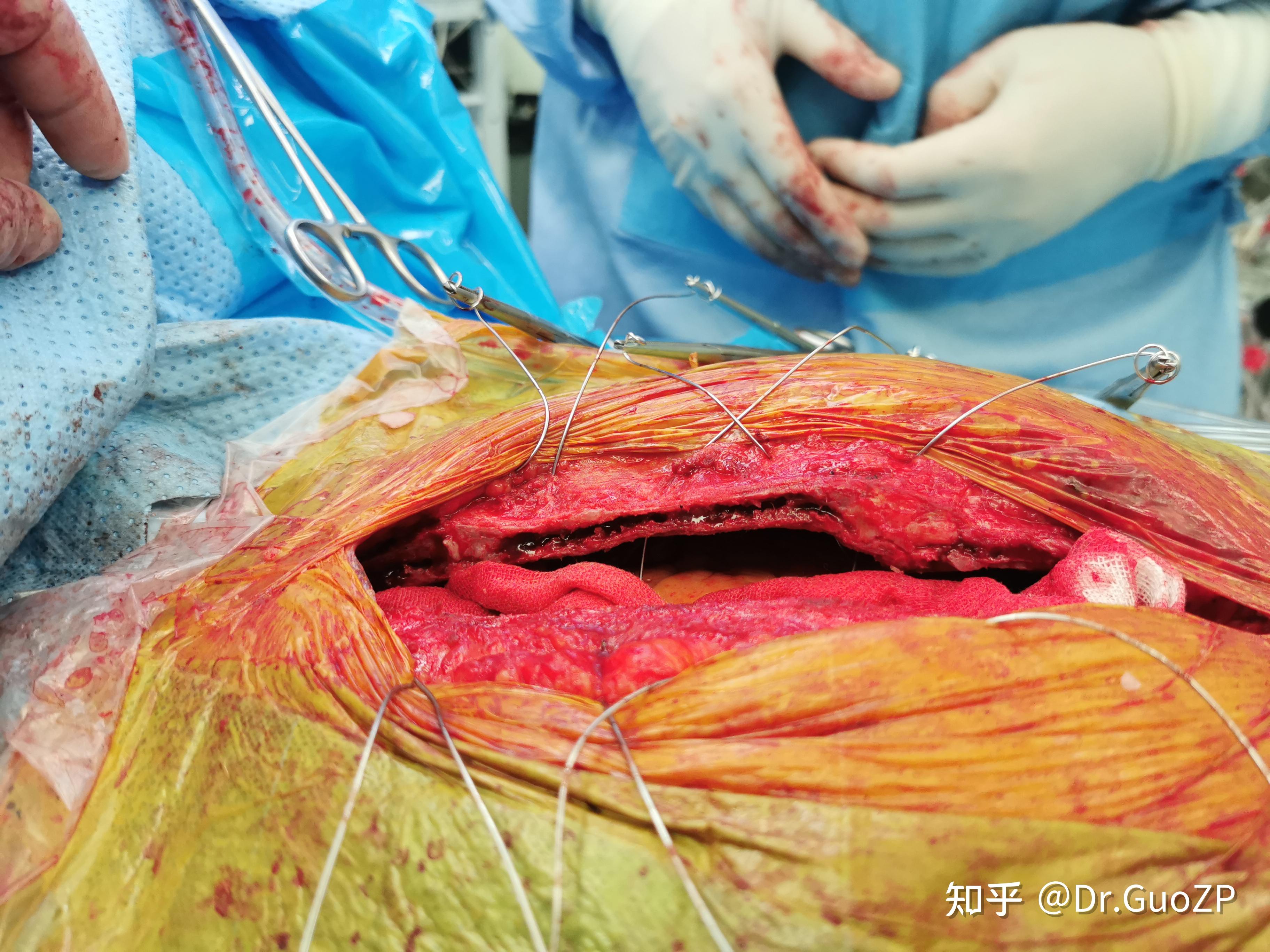 请问做大型的心脏手术要把人的胸骨弄开吗