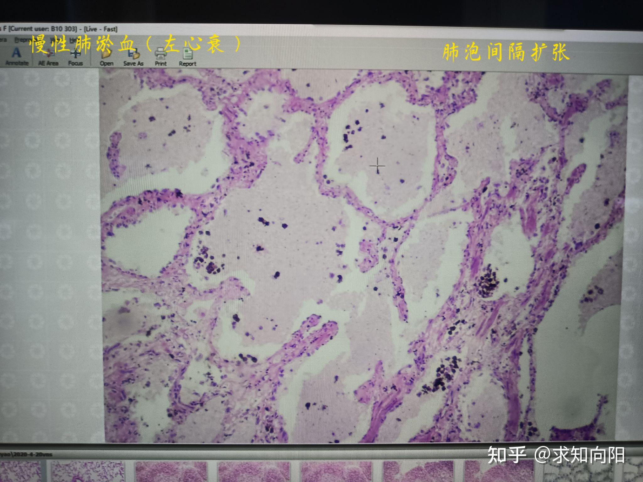 慢性肺淤血显微镜图片