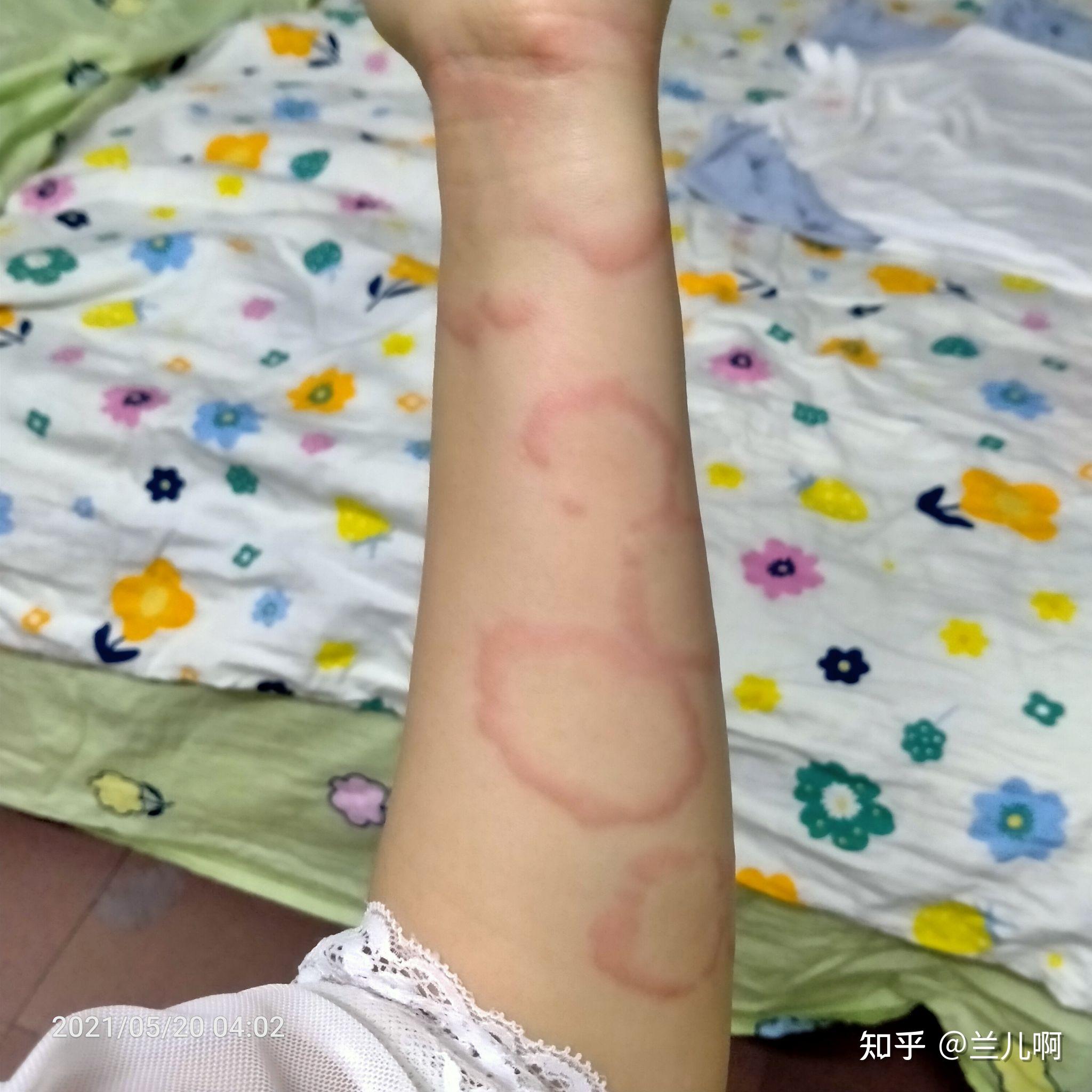 治疗荨麻疹过程 - 知乎