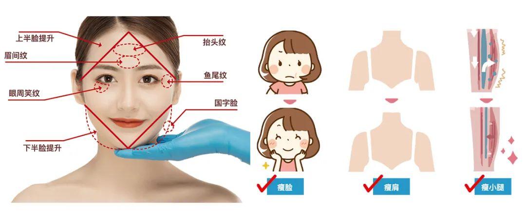 漂亮主义丨肉毒素注射——动态纹抚平,轮廓改善,一针破解 - 知乎