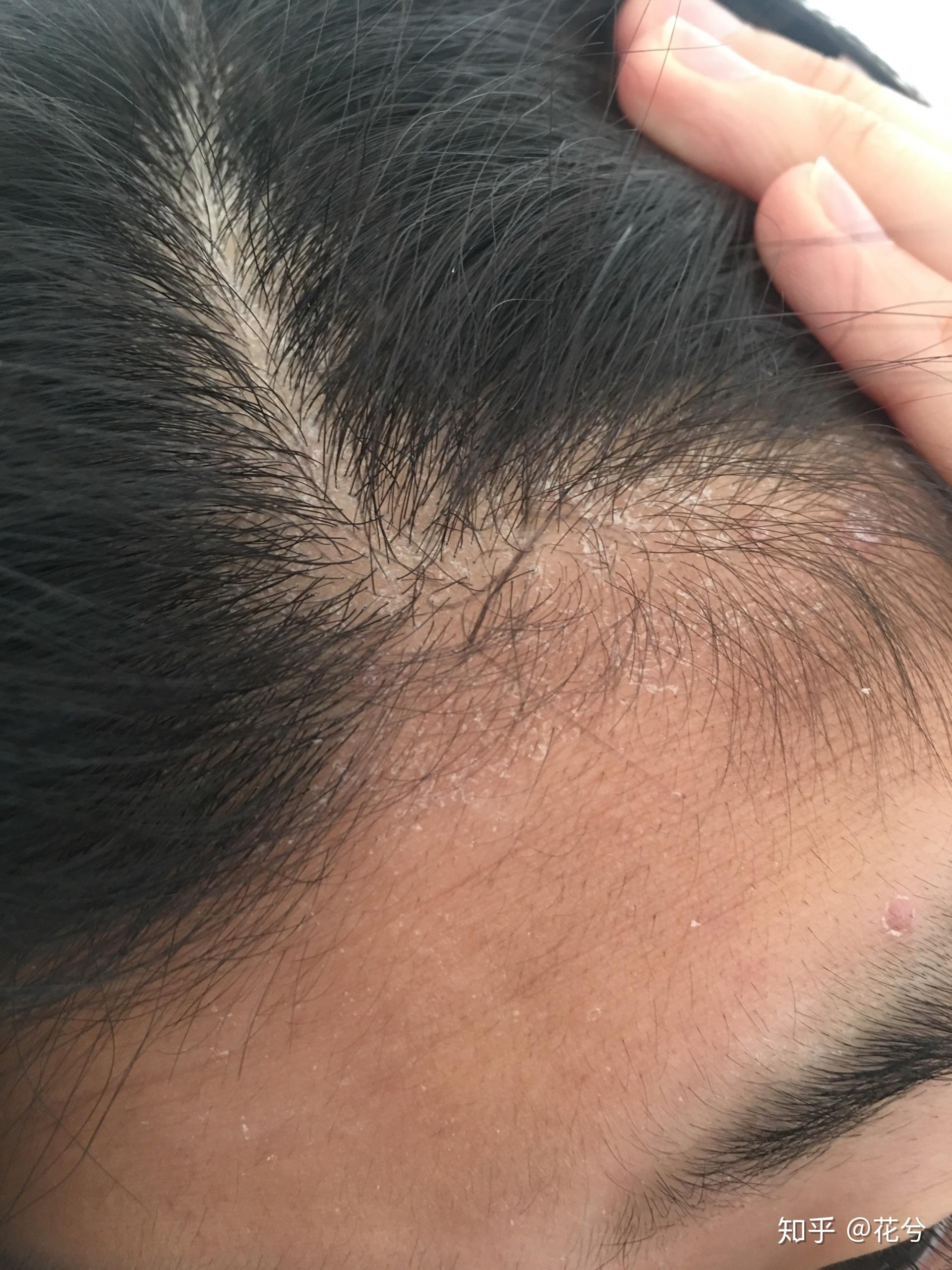 接近发际线的皮肤和头皮起死皮怎么办