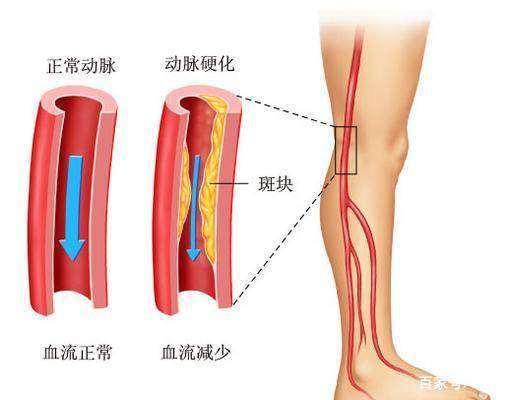 怎么治疗下肢动脉硬化闭塞症 知乎