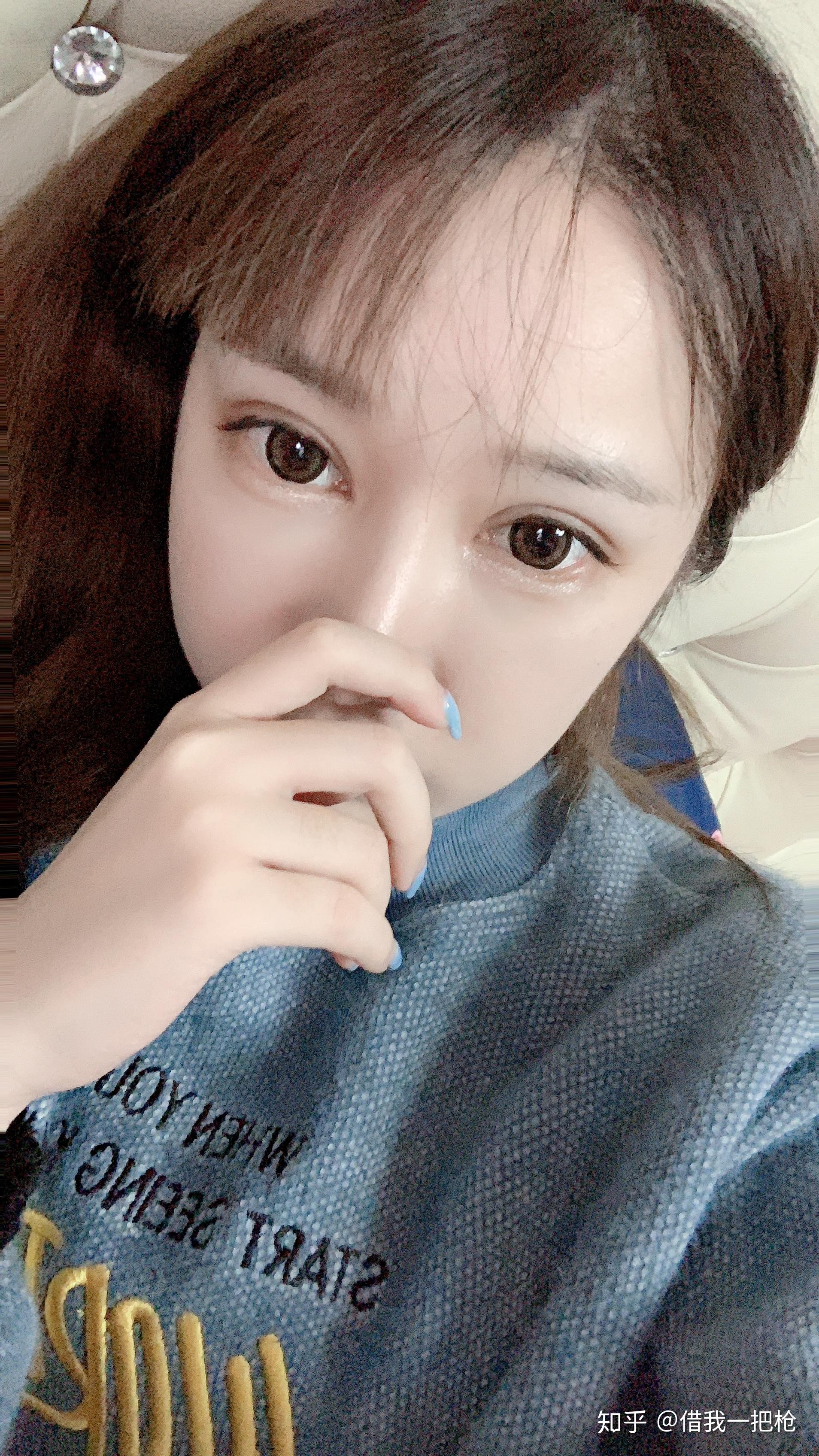 案例分享福州双眼皮哪里好告别我的大小眼双眼皮我来了