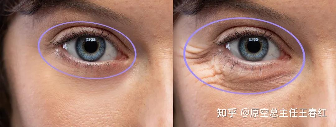 眼周抗衰不靠“填”,靠“稳”住年轻结构!|眶周注射打法揭秘 - 知乎