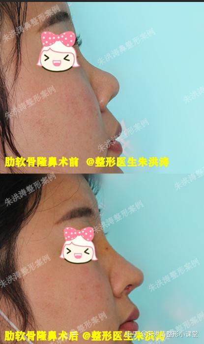 肋骨肋软骨位置图 肋软骨在哪个位置图 肋软骨在身体那个位置