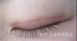 着急想做双眼皮?这些事情你或许应该先了解一下