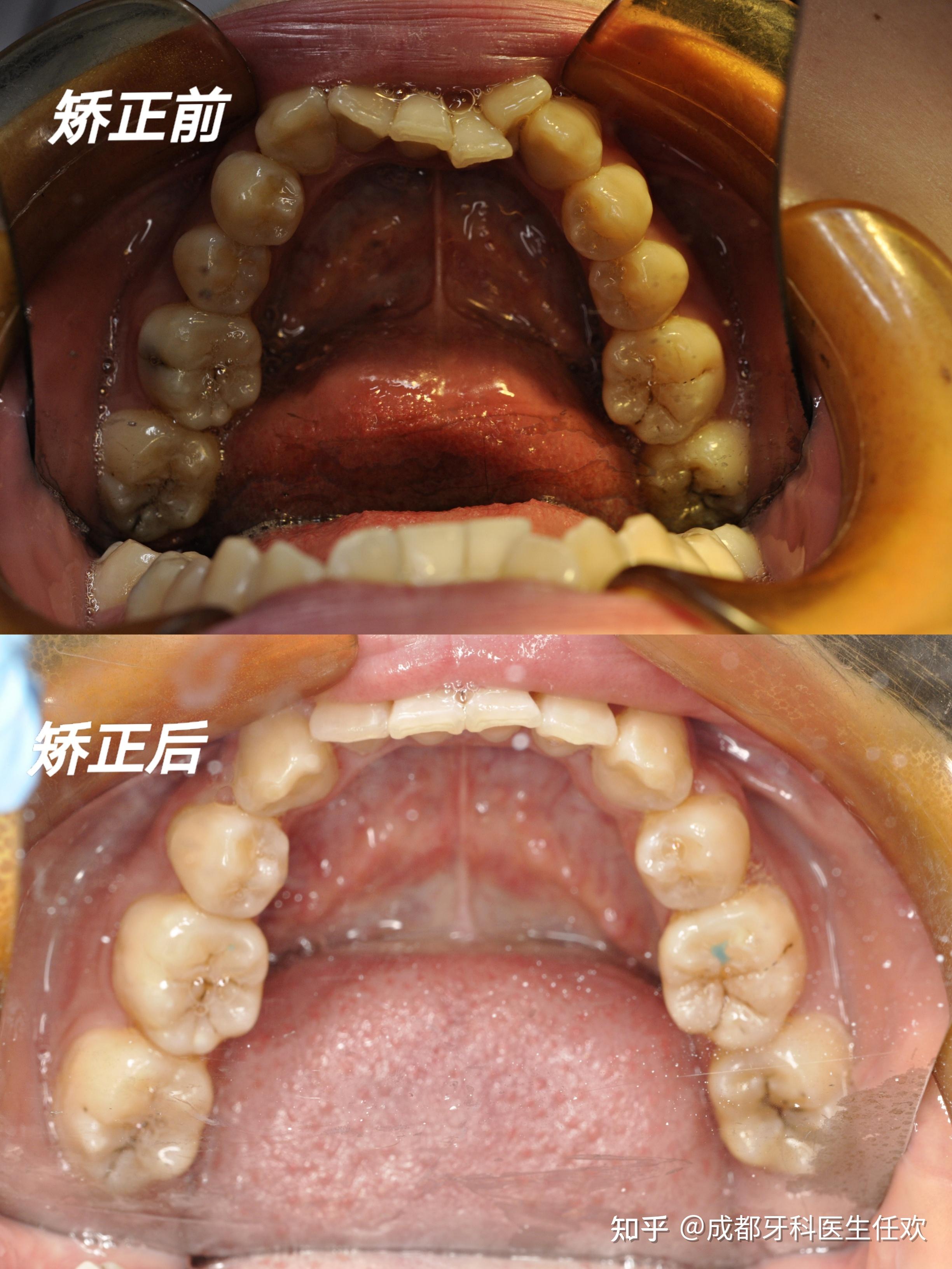 成都牙齿矫正（正畸）【案例】—牙列不齐+个别牙反颌+下颌轻微内收 - 知乎