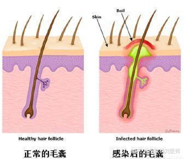 天气变化较大,毛囊炎又起来了? - 知乎