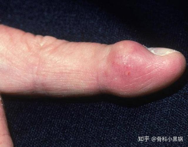 手上长了个包就是腱鞘囊肿囊肿肿物肿瘤别傻傻分不清楚