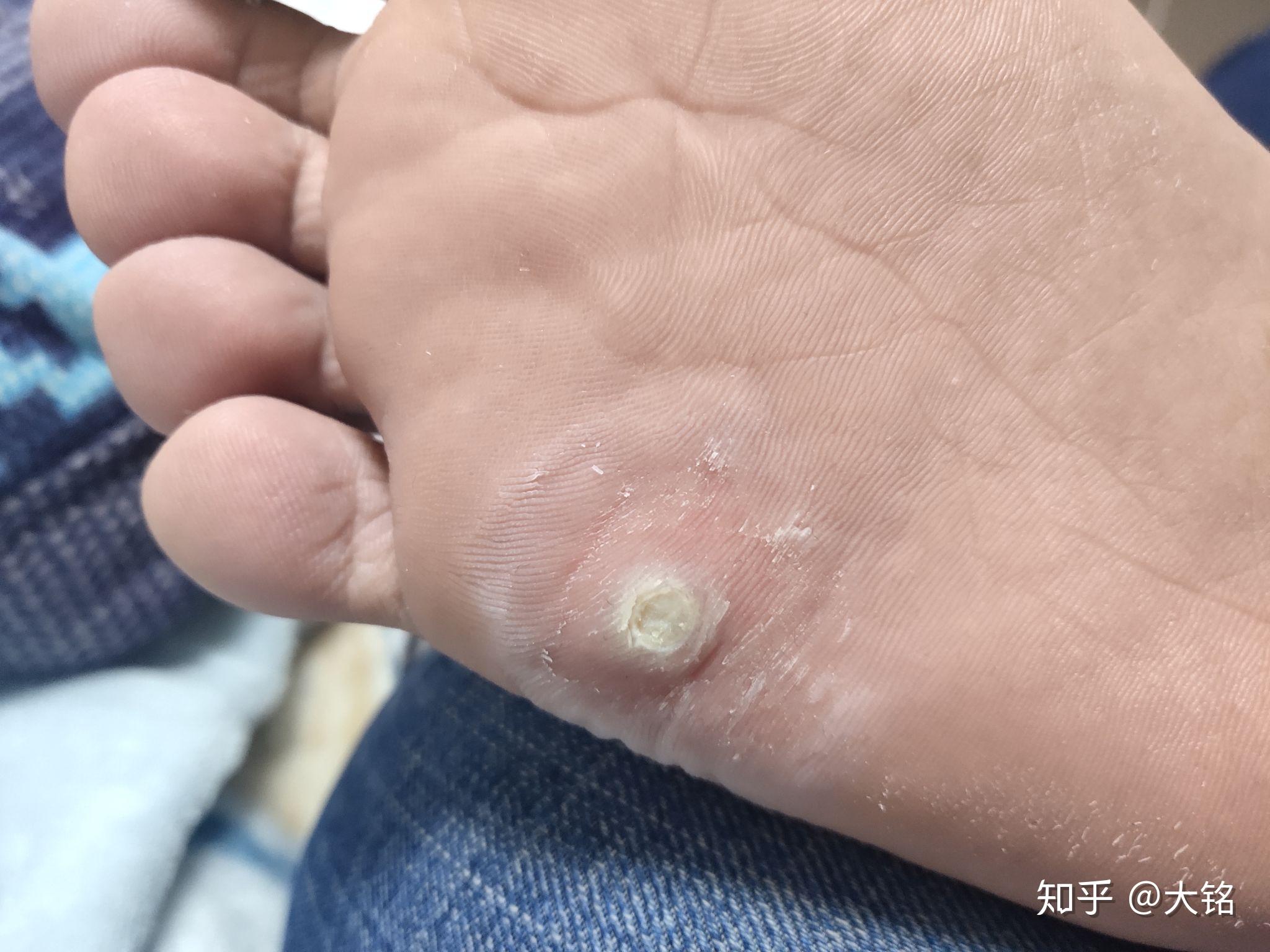 跖疣阿司匹林有图慎点