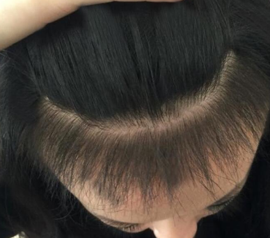 什么是美人尖可以种植吗