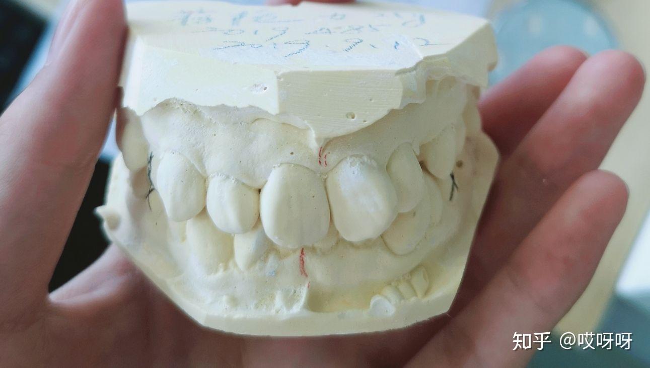 正畸分享|虎牙埋伏牙