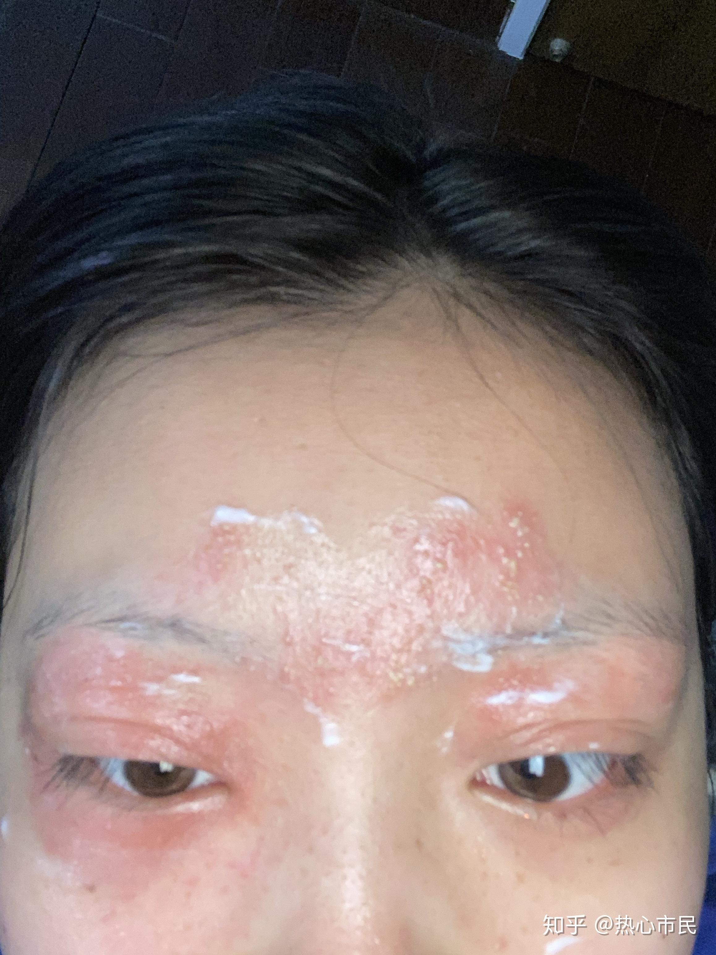 被隐翅虫毒液侵蚀的悲伤心情