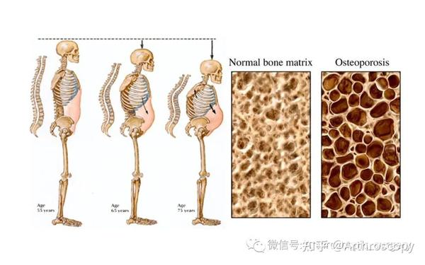 它山之石丨中国老年骨质疏松症诊疗指南解读(2023) - 知乎