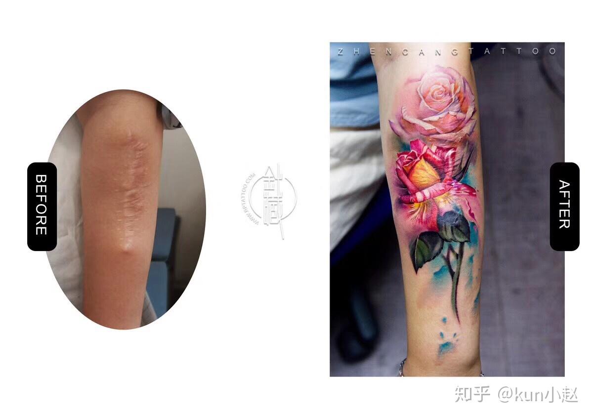 米奇纹身（烟疤遮盖）&手术疤纹身遮盖 #刺青师大龙#|手工艺|其他手工|刺青师大龙 - 原创作品 - 站酷 (ZCOOL)