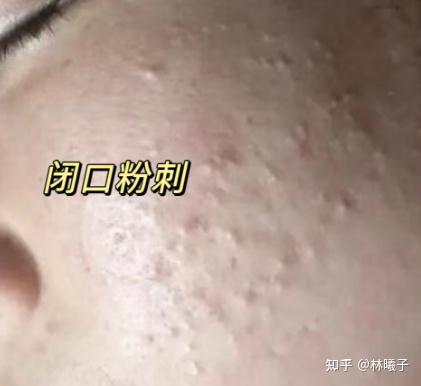 一直针清闭口,但闭口还是长不停,咋办?(去闭口攻略) - 知乎