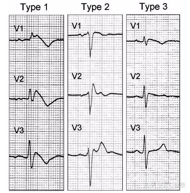 幾種常見致命疾病心電圖