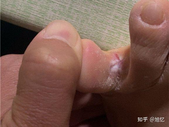 了室友的鞋子然后就被传染上了,刚开始脚上只是起了几个小水泡,有点痒