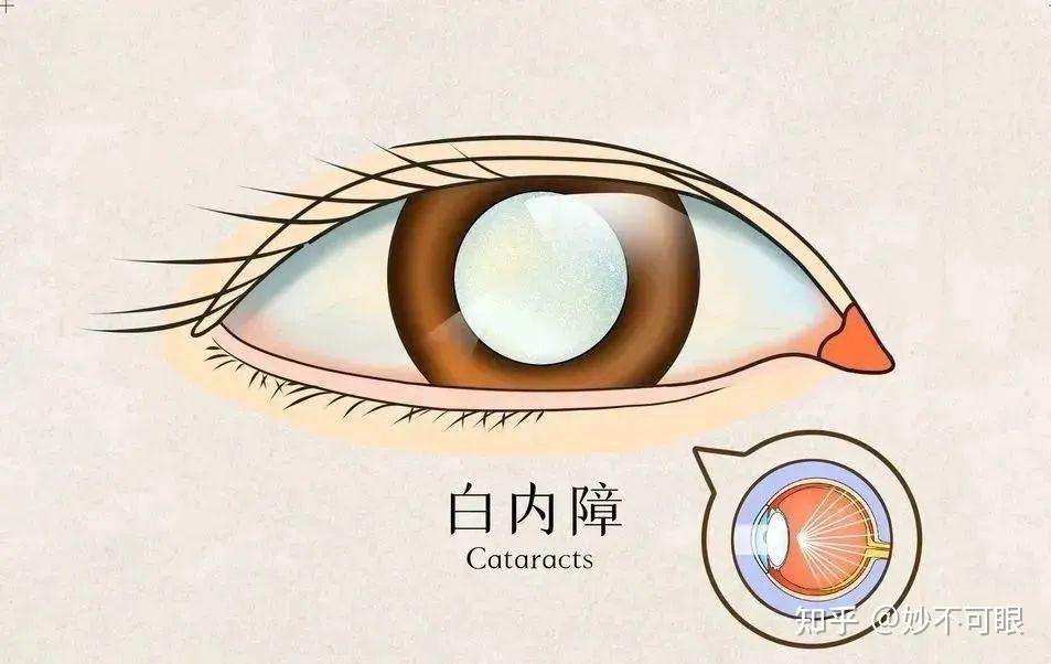 警惕儿童致盲眼病 ----先天性白内障 - 知乎