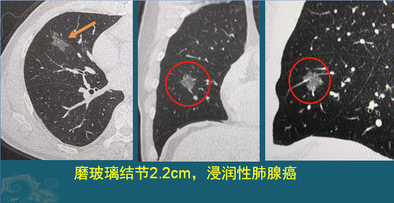 肺癌ct片图片