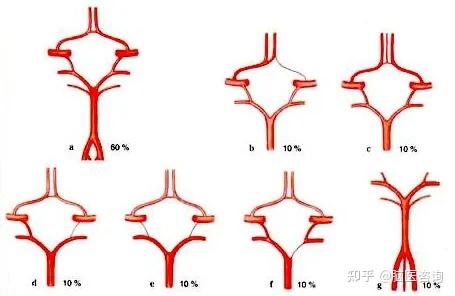 腦血管狹窄必須要做支架嗎