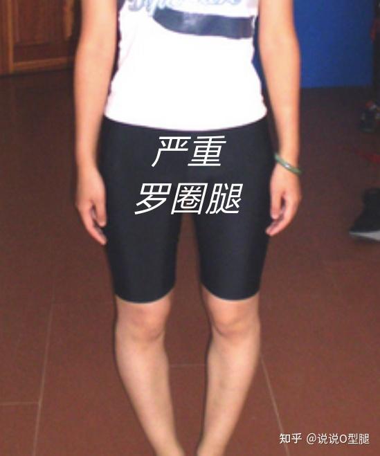 7215严重的罗圈腿,7215严重的x型,举几个栗子,比如:·对修饰