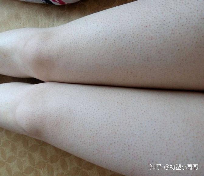甲减患者鸡皮肤怎么治(什么是鸡皮肤,该如何治疗)
