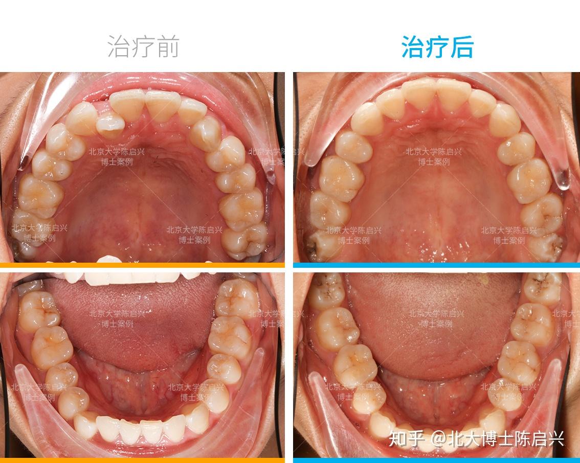 牙齿矫正案例上唇凹陷牙列不齐