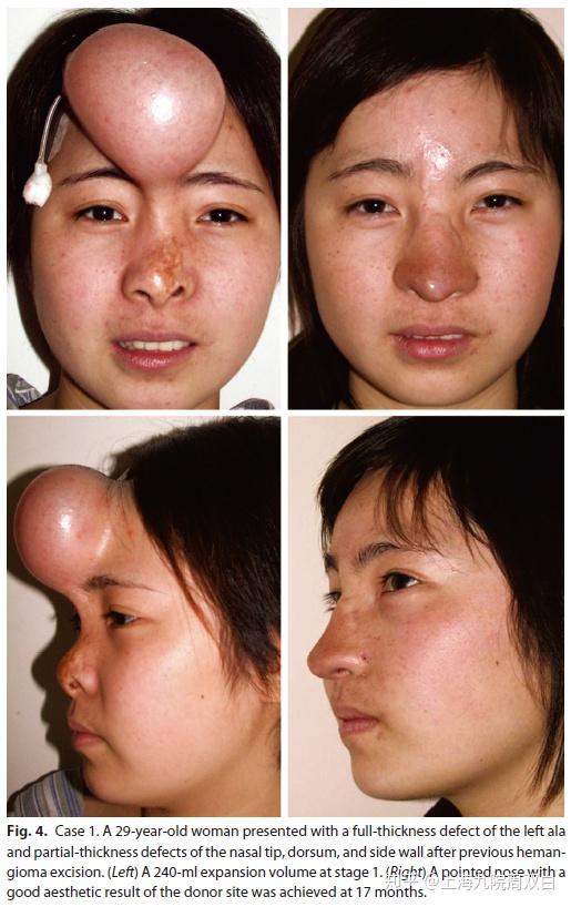 甚至全鼻缺损,对皮肤组织需要量大,可采用皮肤扩张术对额部皮瓣扩张