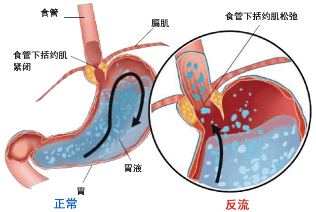 胃食管反流治疗新途径：海藻酸盐 - 知乎
