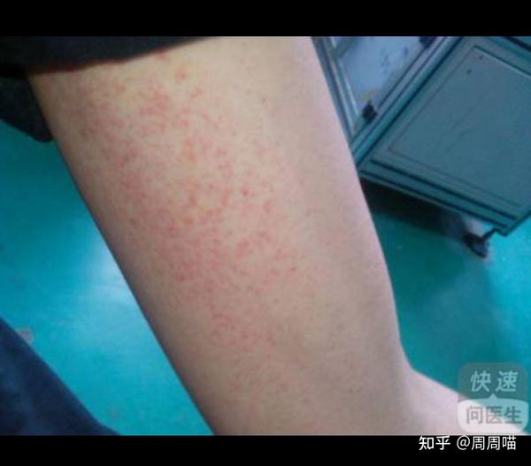 艾滋病锁骨红点图 锁骨周围长好多红点点 男性艾滋病前兆症状图