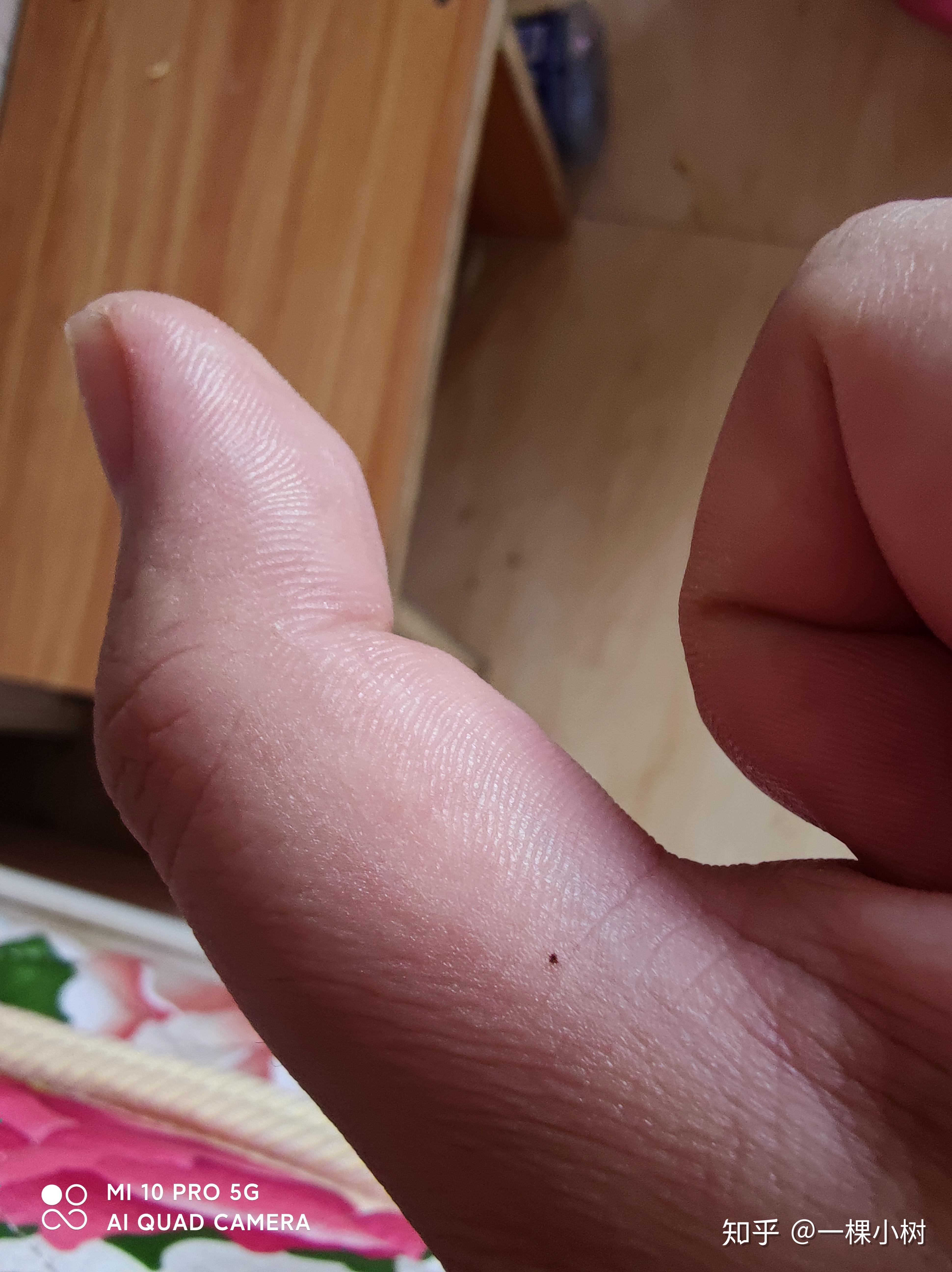 手背上突然长一颗痣是怎么回事