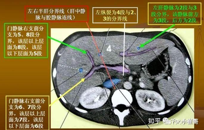 从上面的ct图,我们大致了解,s1和s4在肝脏的中间,s2和s3在肝脏的左边