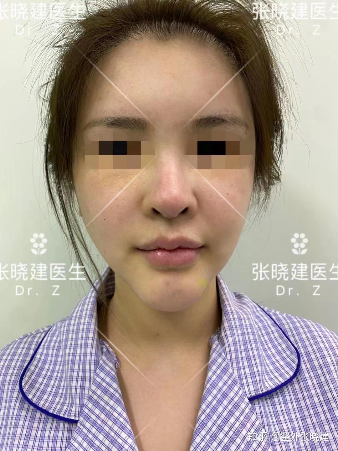 30歲姑娘鼻子+下巴修復，術後即刻到23天實拍，自然如「媽生」 - 資訊咖