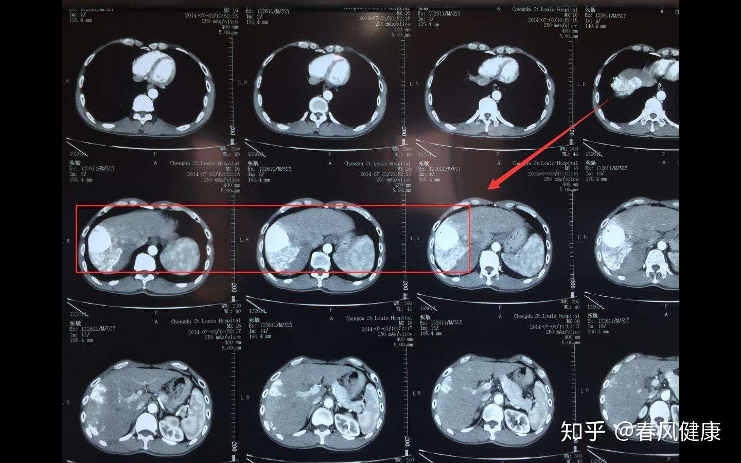 肺癌早期症状 - 搜狗百科