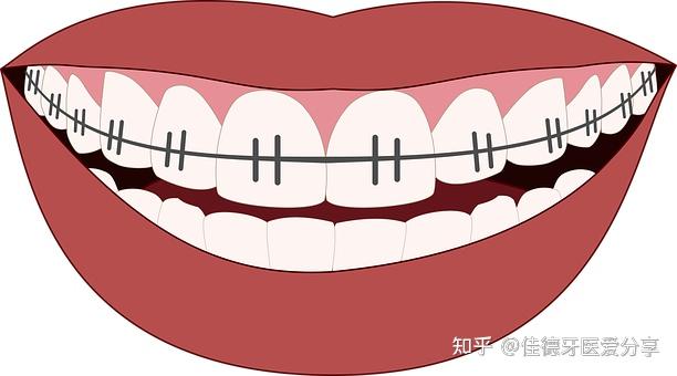 牙齿矫正要一两年能加快正畸速度吗