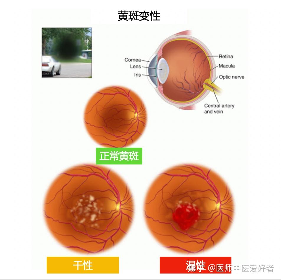 黄斑变性 - 知乎