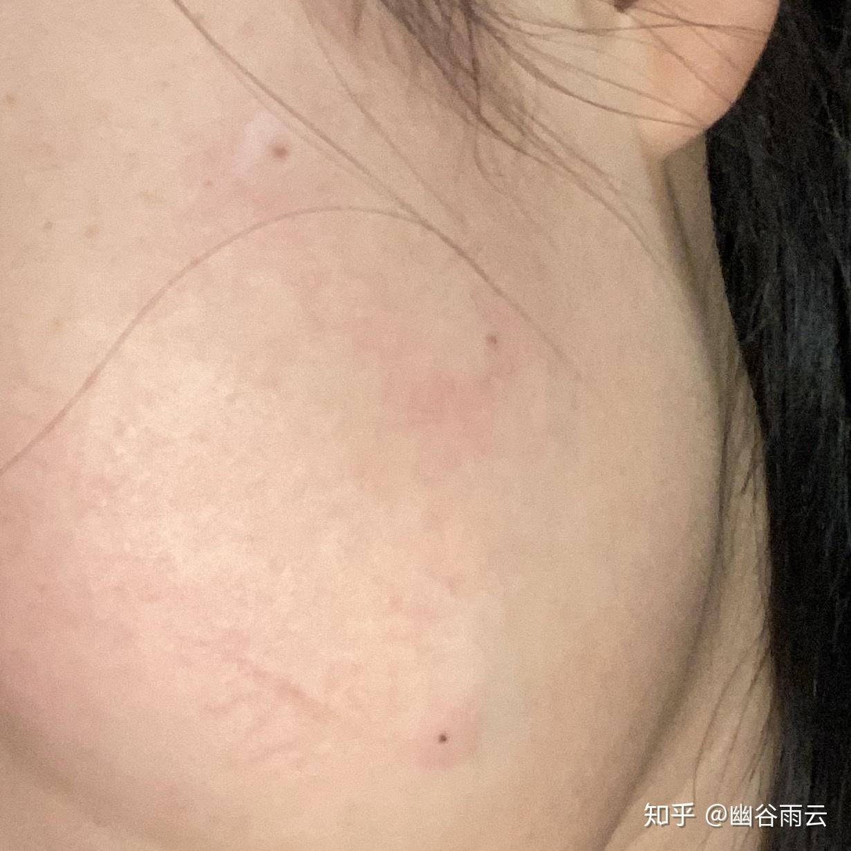 亲身体验醋精和白面祛斑点痣靠谱吗多图预警