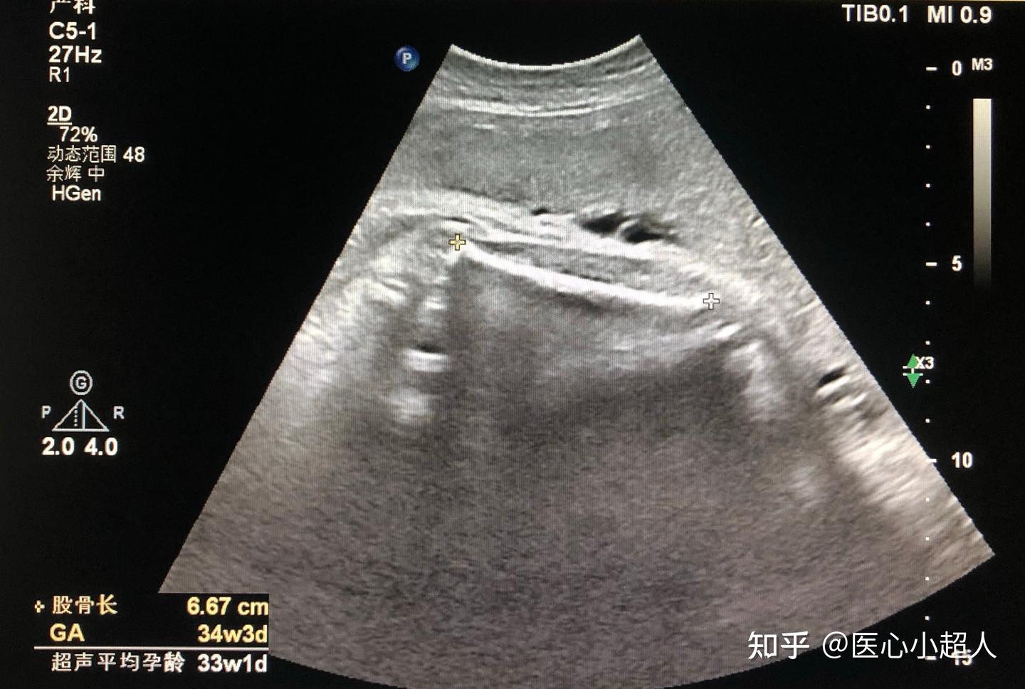 中晚期妊娠胎儿超声解剖特点- 知乎