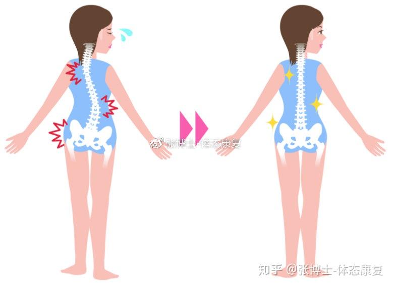 譯文分享關於脊柱側彎的綜述原因類型康復與運動建議