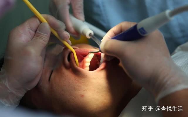 洗牙到底好不好真的会把牙齿洗松吗看完这篇全明白了