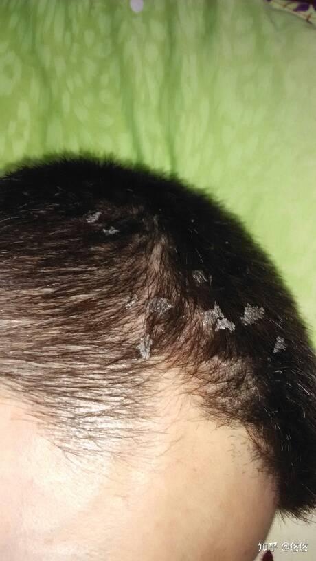 大块大块地掉头皮屑,有什么好用的男士去屑洗发水推荐?