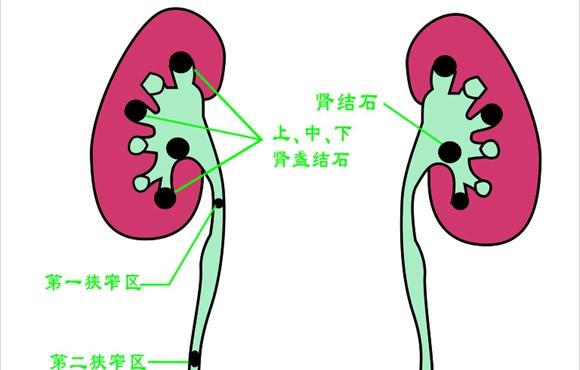 直径一点五厘米以上的单颗结石病例