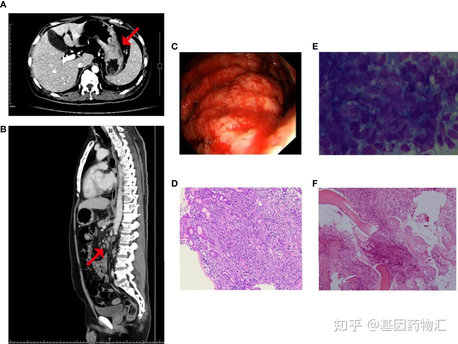 腹膜後,縱隔及雙側肺門區多處淋巴結轉移,且存在廣泛的全身性骨轉移