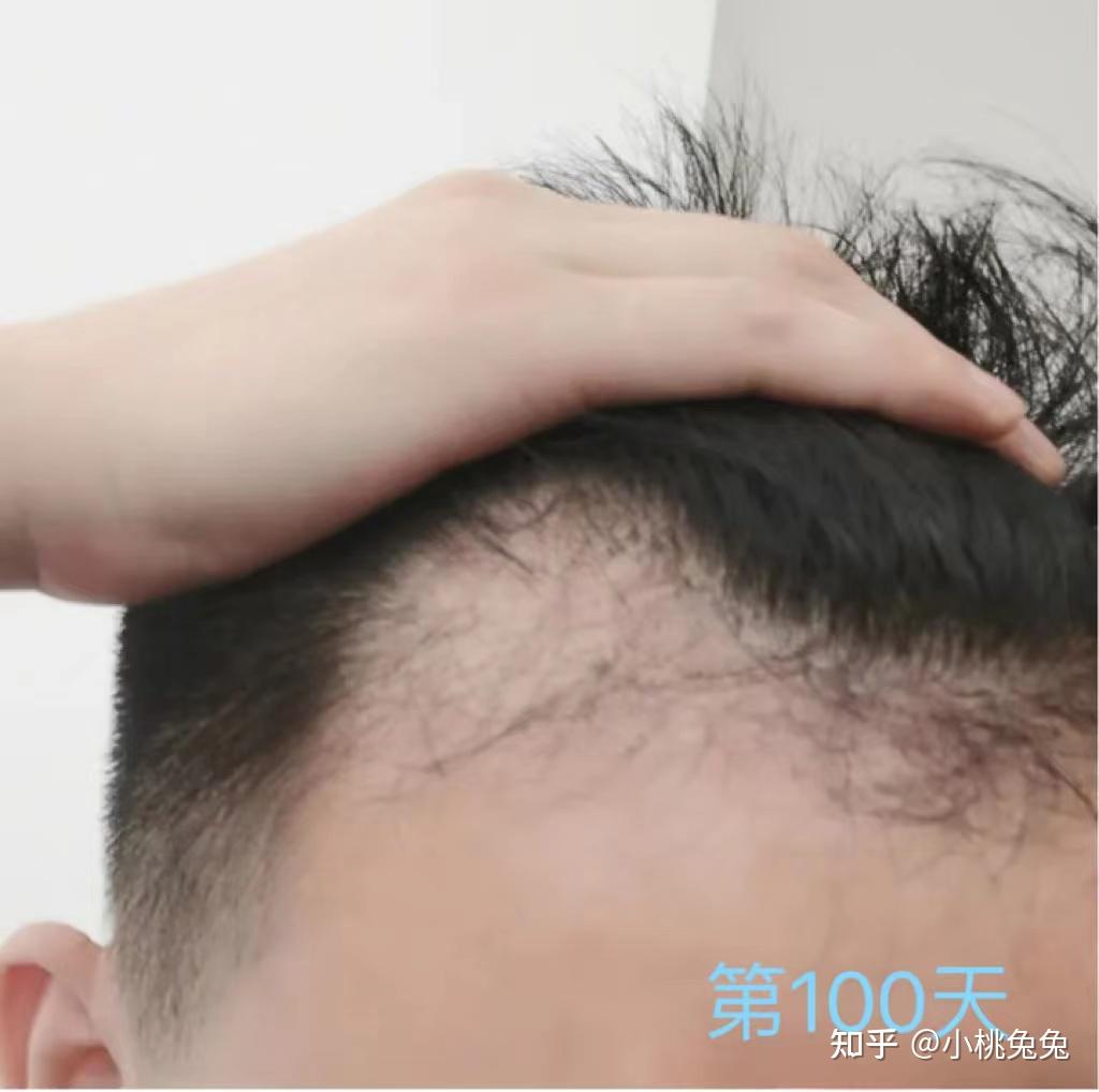 哪里能植发只荐新生3d植发的简单介绍