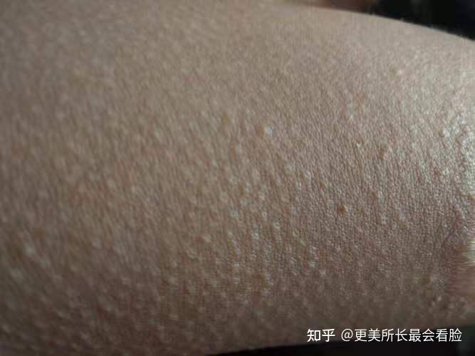 鸡皮肤里面有白疙瘩(鸡皮肤里的白色是什么)