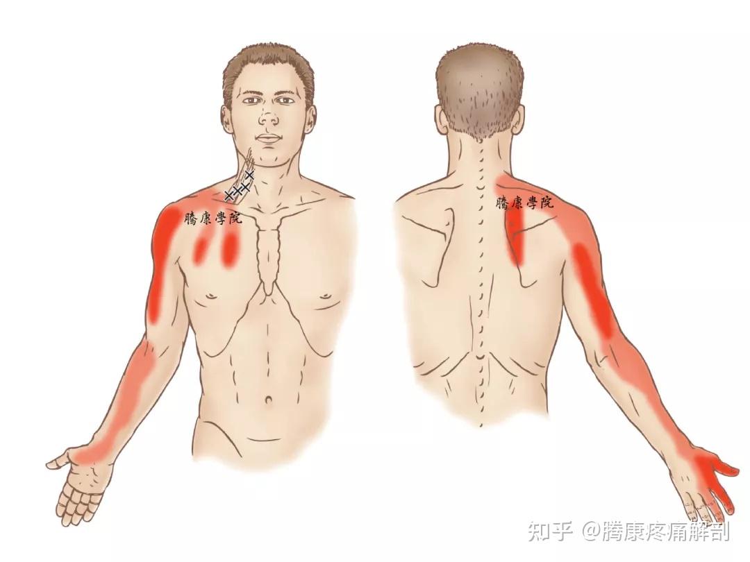 前斜角肌综合征的发生机制和治疗