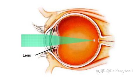 屈光近视手术基础知识科普——仅矫正视力已经过时了 - 知乎