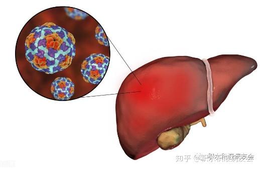 肝硬化患者壽命不長做到以下幾點可最大程度延長生命週期